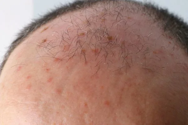 Actinic Keratoses Merthyr Tydf