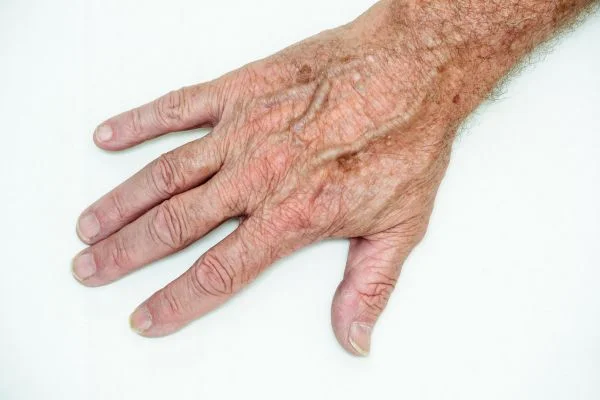 age spot removal Merthyr Tydf