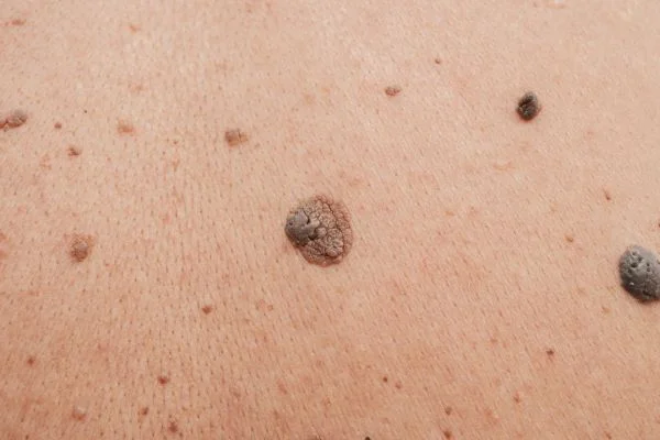 Benign Moles Merthyr Tydf