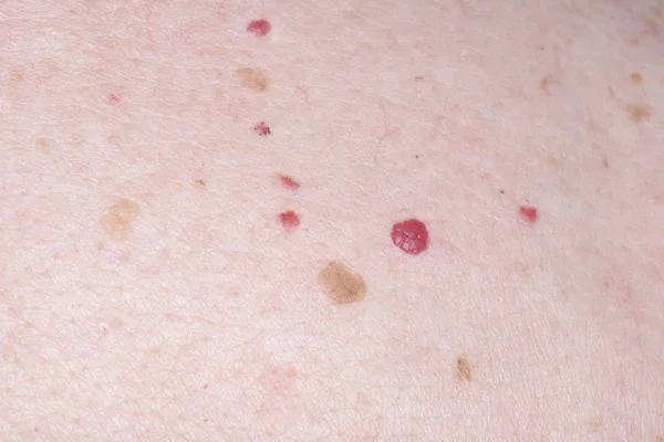 Cherry Angiomas Merthyr Tydf