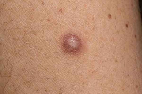 Dermatofibromas