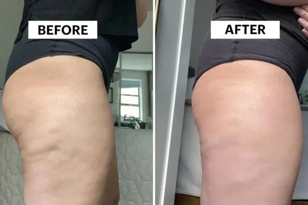 Body Sculpting Results Merthyr Tydf