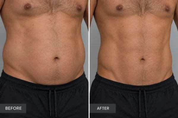 Body sculpting results Merthyr Tydf