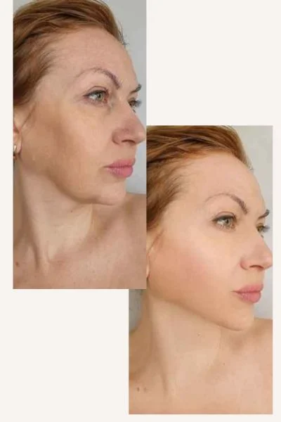HIFU Results Merthyr Tydf before and after