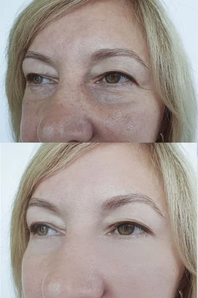 collagen lift 360 results Merthyr Tydf