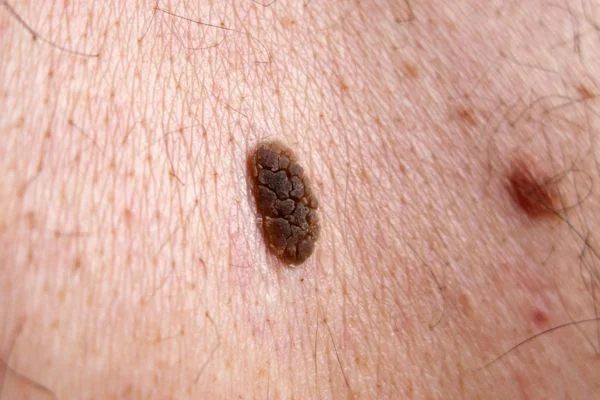 Seborrhoeic Keratoses removal Merthyr Tydf