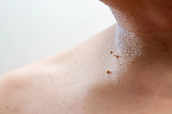 skin tag removal Merthyr Tydf